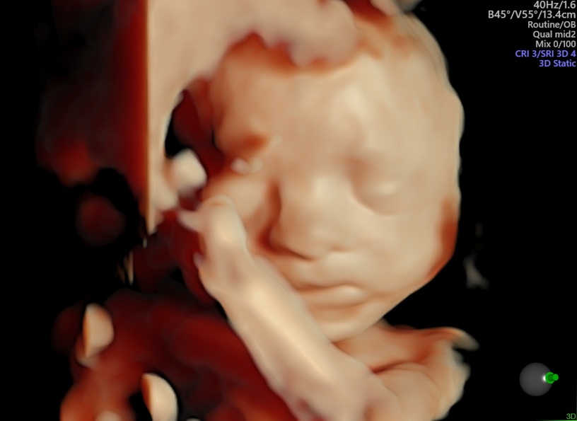 Ecografía de la bebé